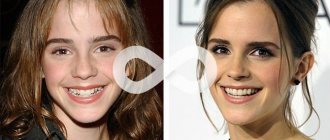 10 stars who wore braces - all about childhood diseases on IllnessNews.ru