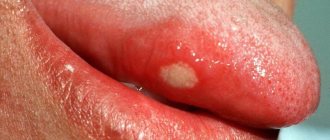 Abscess on the tongue