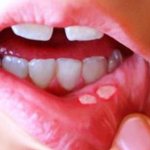 aphthous stomatitis