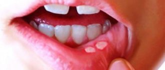 aphthous stomatitis