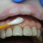 Application anesthesia for dental treatment