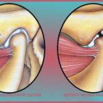 Arthritis of the jaw