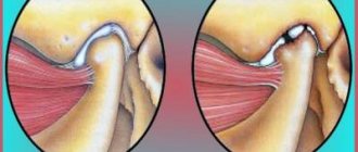 Arthritis of the jaw