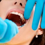 Болит десна после удаления зуба - Стоматология «Линия Улыбки»