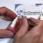 Braces in ovation r price