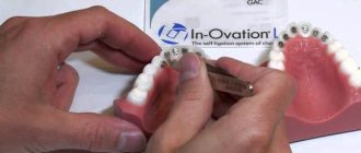 Braces in ovation r price