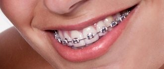 Braces