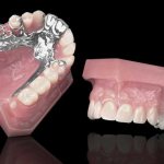 Clasp dentures