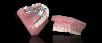 Clasp dentures