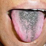 Black tongue