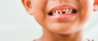 What to do if a child’s enamel peels off?