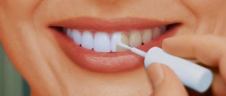 What is dental varnish?