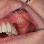 Декумбитальная язва в полости рта