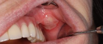 Decumbital ulcer in the mouth