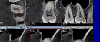 Dentals on X-ray