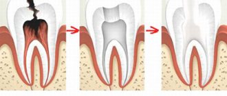 Депульпирование зуба протезирование