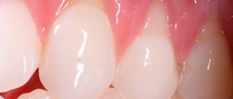 gum moving away from tooth photo