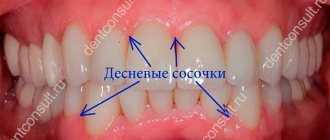 Gingival papillae