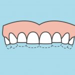 Children&#39;s bruxism in pictures