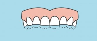 Children&#39;s bruxism in pictures