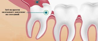 Diagnosis and treatment of pericoronitis