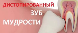 Дистопированный зуб мудрости удалить или вылечить