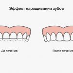 Эффект от наращивания зубов в картинках