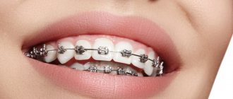 aligners after braces