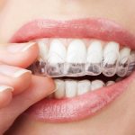 Aligners