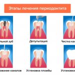 Stages of periodontitis treatment in pictures
