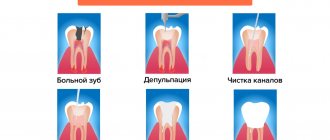 Этапы лечения периодонтита в картинках