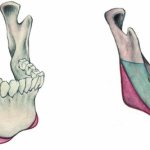 Stages of mandibuloplasty