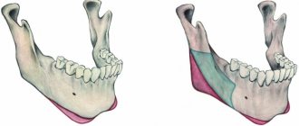 Stages of mandibuloplasty