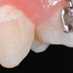 Stages of caries development under braces