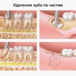 Stages of tooth extraction in parts in pictures