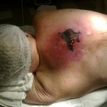 Cellulitis of the back