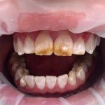 Fluorosis