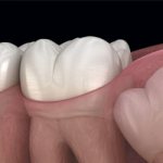 Formation of a hollow tumor on the bone in the figure eight area - Dentistry &quot;Line of Smiles&quot;