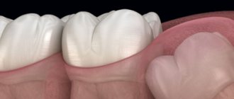 Formation of a hollow tumor on the bone in the figure eight area - Dentistry &quot;Line of Smiles&quot;