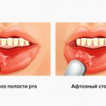 Photos of allergic stomatitis in pictures