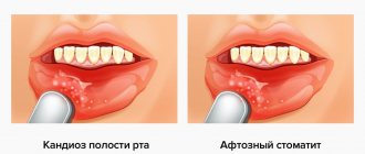 Photos of allergic stomatitis in pictures