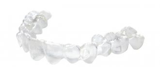 Photos of aligners