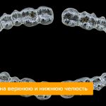 Photos of aligners for the upper and lower jaw