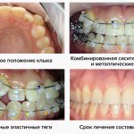 Фото на разных этапах лечения безлигатурными брекетами