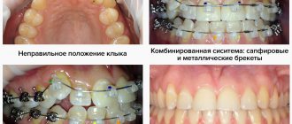 Фото на разных этапах лечения безлигатурными брекетами