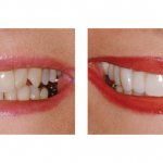 Photo of the patient before and after installation of lumineers on teeth