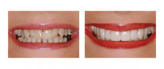 Photo of the patient before and after installation of lumineers on teeth