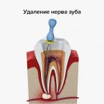 Photo of the process of removing a nerve from a tooth canal with pulpitis