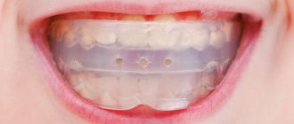 Photos of teeth trainers