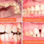 Photos of types of malocclusion